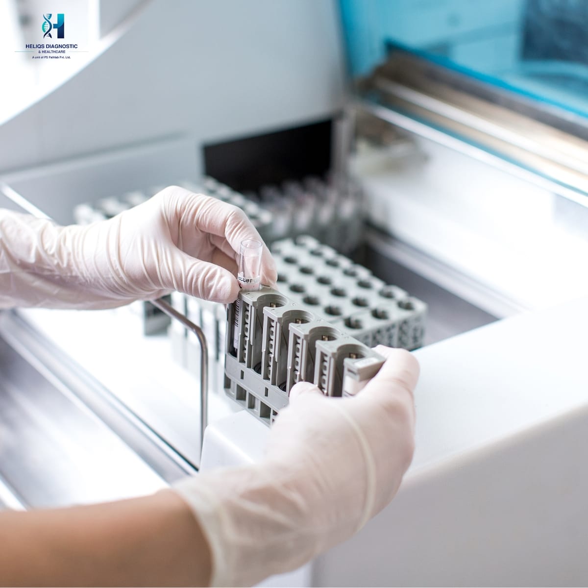 A gloved lab technician placing a rack of test tubes into an automated clinical chemistry analyzer for diagnostic testing.